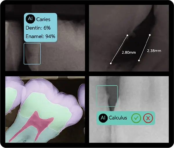 Dental X-rays